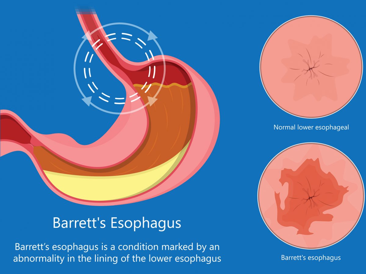 Upper GI Kingwood GI Gastroenterology Clinic