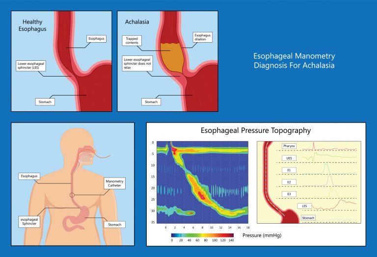 Esophageal Manometry Kingwood GI Gastroenterology Clinic