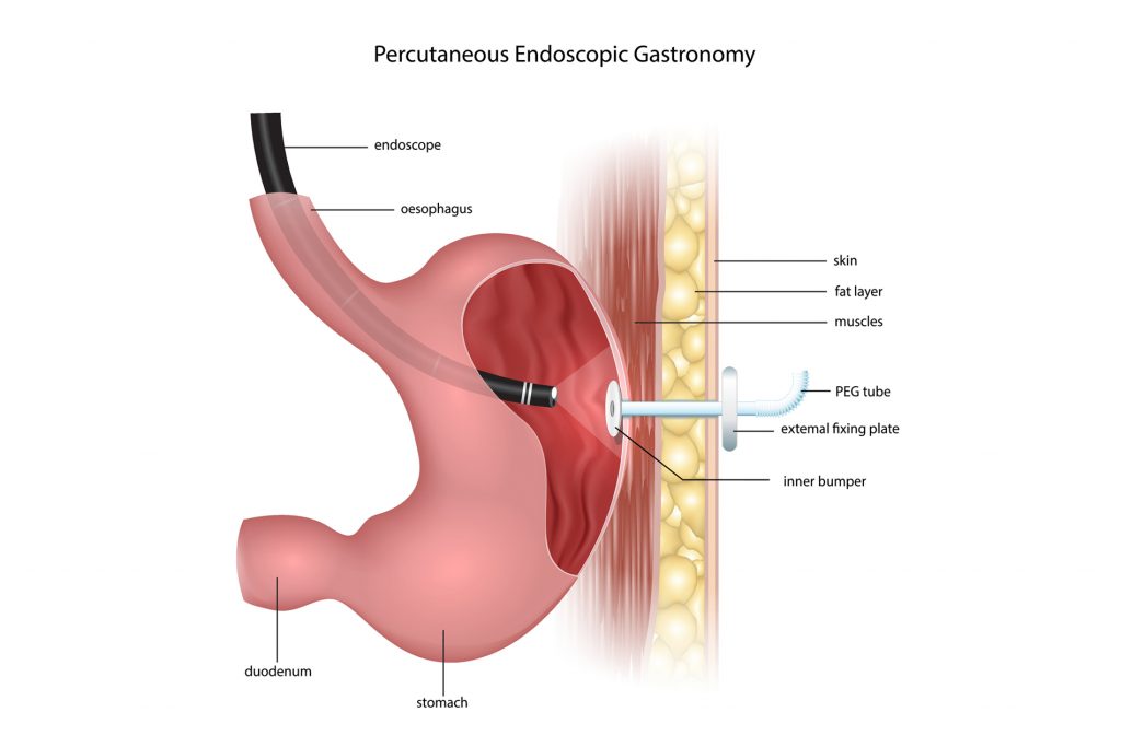 gastric feeding tube